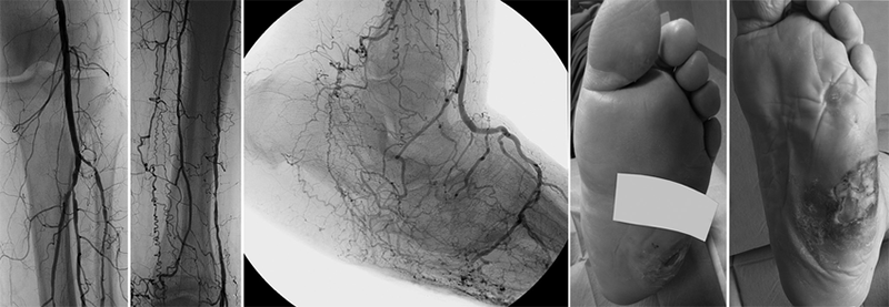 آنژیوگرافی پای دیابتی