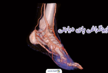 آنژیوگرافی پای دیابتی