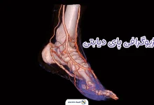 آنژیوگرافی پای دیابتی