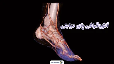 آنژیوگرافی پای دیابتی