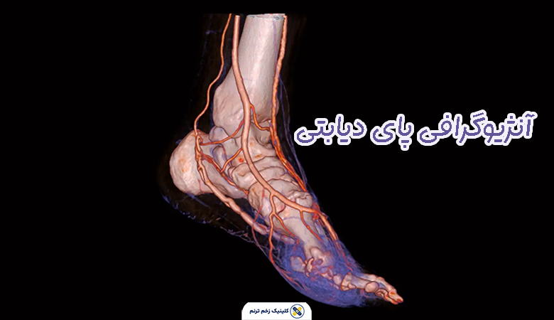 آنژیوگرافی پای دیابتی