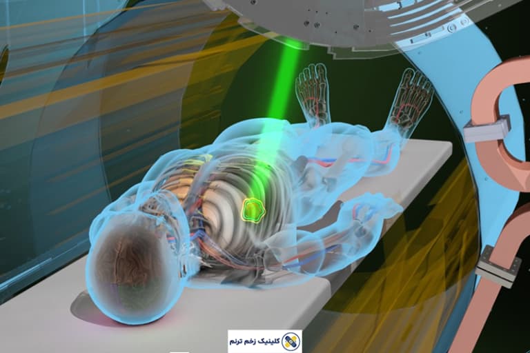 رادیو تراپی زخم بدخیم