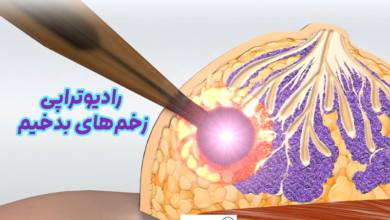 رادیوتراپی