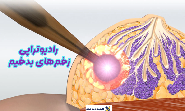 رادیوتراپی