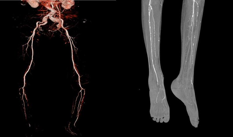 آنژیوگرافی پای دیابتی