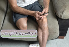 آمپوتاسیون