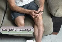 آمپوتاسیون