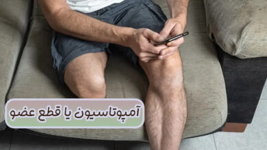 آمپوتاسیون