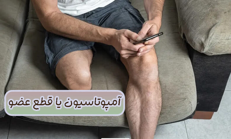 آمپوتاسیون