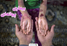 بیماری پروانه‌ای