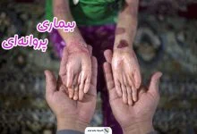 بیماری پروانه‌ای