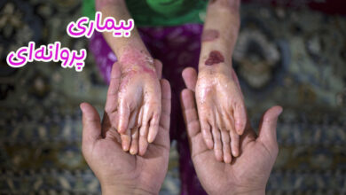 بیماری پروانه‌ای