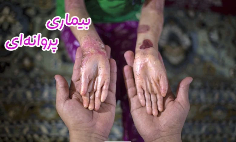 بیماری پروانه‌ای
