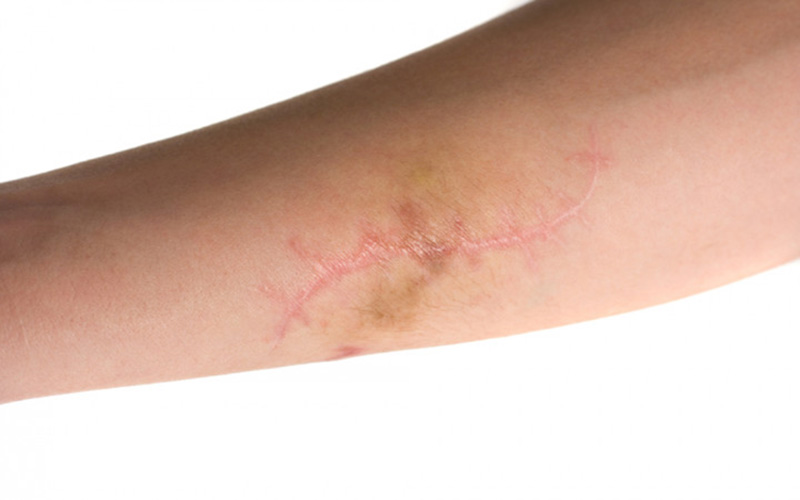 درمان زخم بریدگی