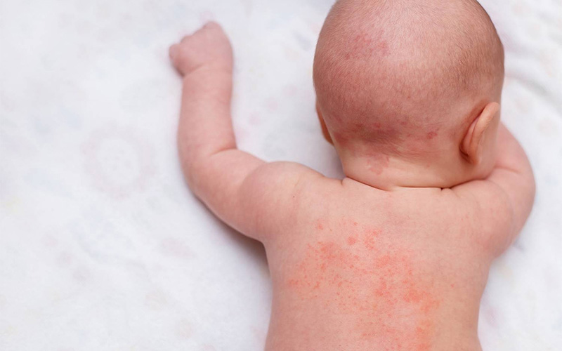 بیماری پروانهای در بارداری