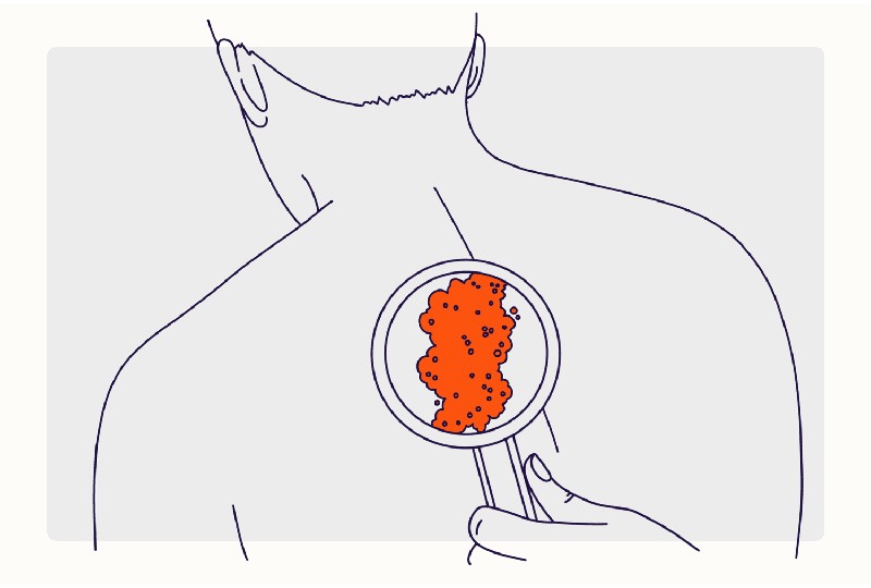 عفونت پوستی