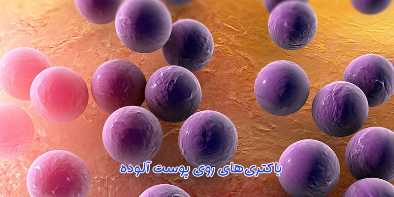 عفونت پوستی