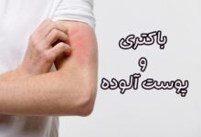 عفونت پوستی