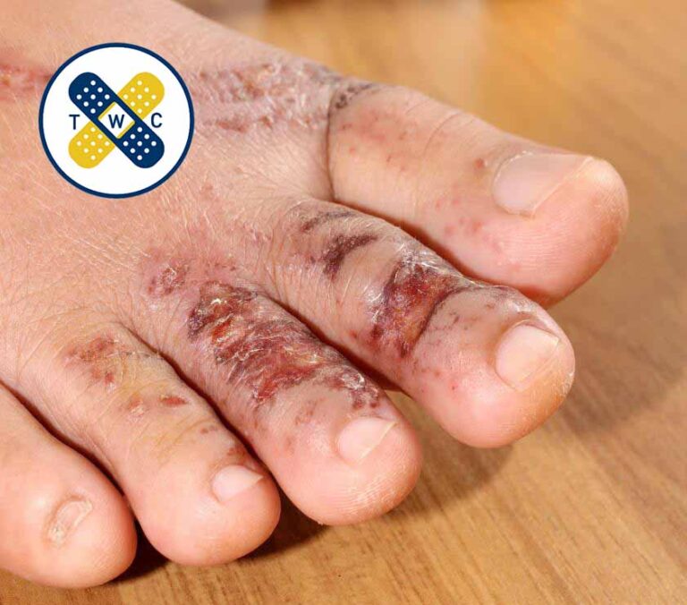 تاول در پای افراد دیابتی تاول سوختگی تاول ناشی از کفش نامناسب مرکز تخصصی ترنم