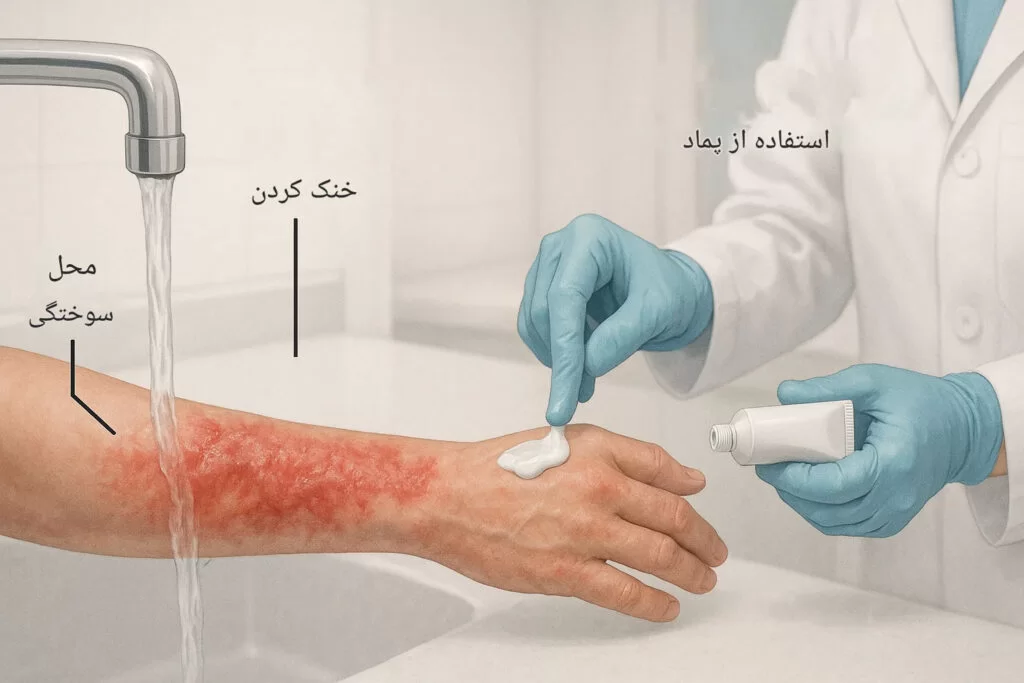 سوختگی با آب جوش