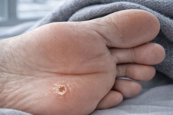 زخم پای دیابتی و زمستان