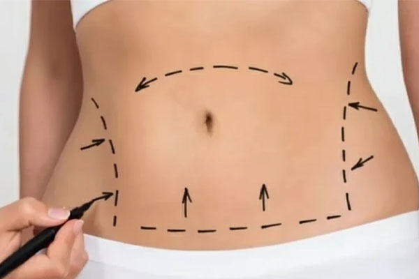 درمان زخم ابدومینوپلاستی