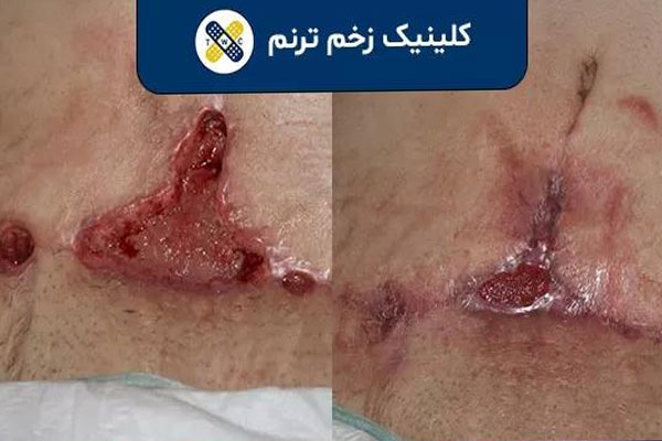 درمان زخم ابدومینوپلاستی