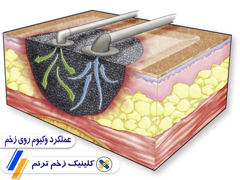 عملکرد وکیوم تراپی زخم