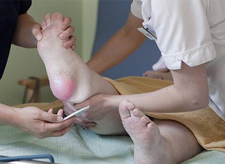 درمان زخم بستر در منزل تهران و کرج