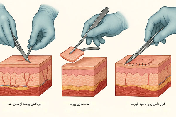 پیوند پوست