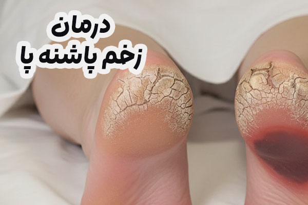 درمان زخم پاشنه پا