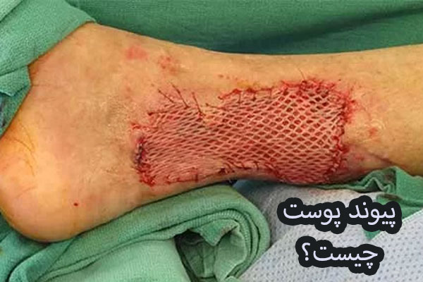 پیوند پوست