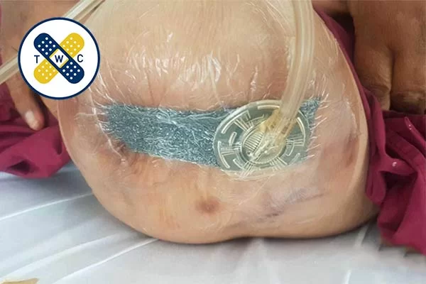 مزایای وکیوم تراپی زخم بستر