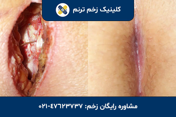 تصاویر قبل و بعد درمان زخم در کلینیک زخم