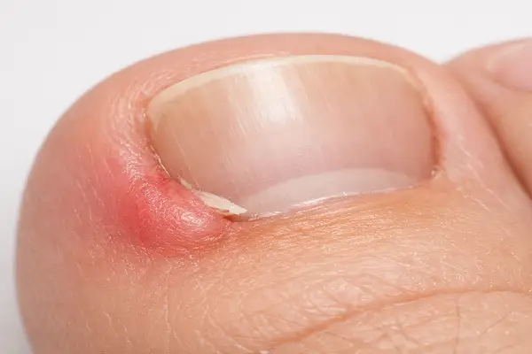 ناخن فرو رفته در انگشت پا 
