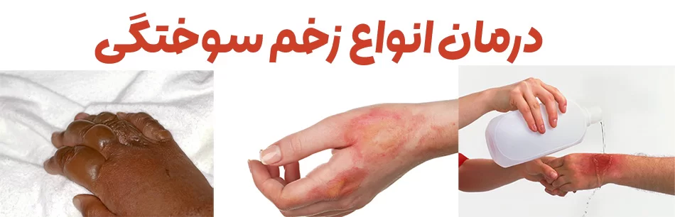 درمان-زخم-سوختگی